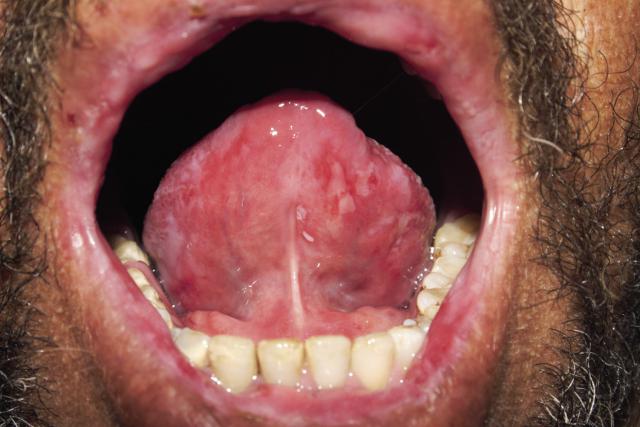 hiv bumps on tongue