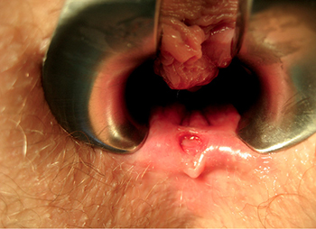Can anal fissure cause severe bleeding